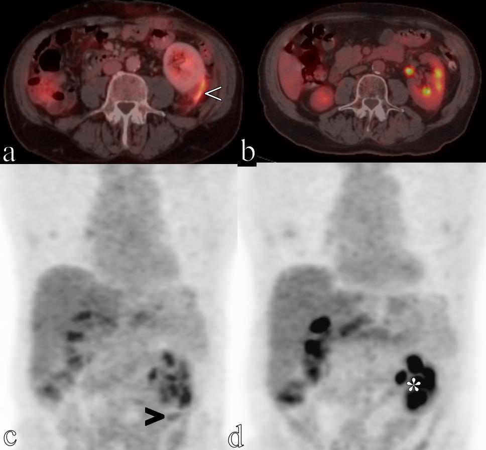 Figure 6: These are images of an 18FDG PET-CT scan immediately following the biopsy (a and c) and four months after completion of radiation in a 77 year-old male diagnosed with primary renal lymphoma.