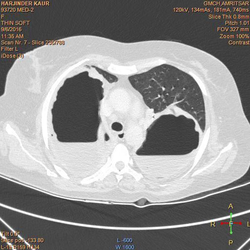Fig. 3 showing CECT scan of the