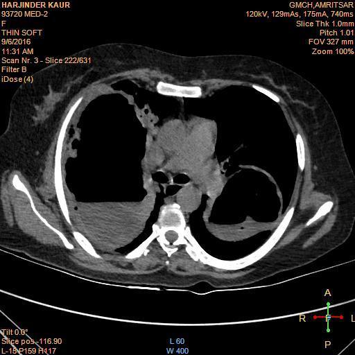 Fig. 4 showing CECT scan of the chest showing bilateral lung abscesses Discussion Lung abscess is a type of liquefactive necrosis of the lung tissue and formation of cavities (more than 2 cm)