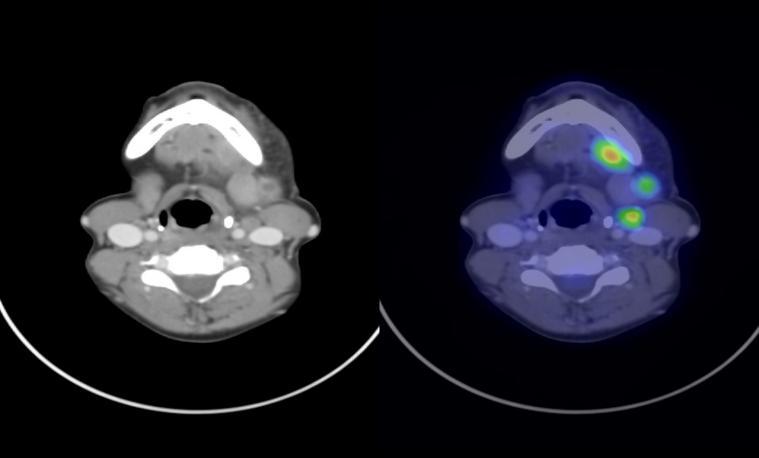 Figure.4 showing CECT and PET/CT of a patient with nodal metastasis Distant metastasis was identified by PET/CT in 2 patients.