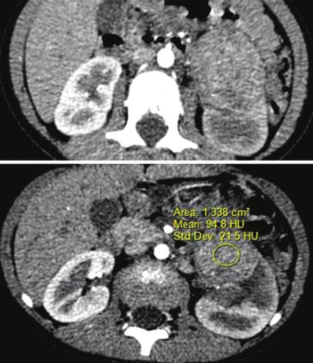 tumor/aorta enhancement ratio was <0.3 (0.15-0.23) (Table 4). All the observed lesions showed perinephric spread. No spread was observed to the adjacent organs, renal vein, and ureter.
