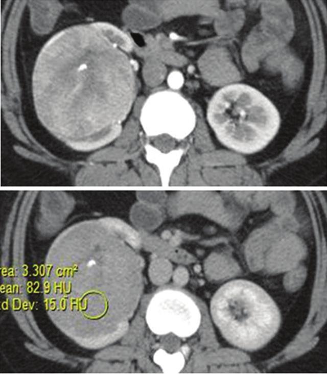 Figure 3: Translocation RCC: Well marginated, homogenously enhancing Mass lesion in the left kidney. No calcifications within.