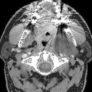 symmetrical changes Neoplasms May be invisible on CT