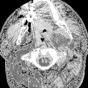 TMJ masses CT or MRI CECT Acinic cell ca *Parotid