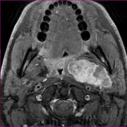 Oropharyngeal pleomorphic deep lobe adenoma mass *MR