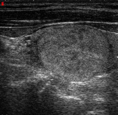 Solid lesion with well-defined halo Ultrasound