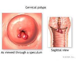 Anovulation Cervical polyps Endometriosis Differential Diagnosis of AUB 26-35 years of age