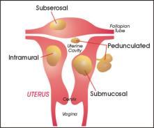 Differential Diagnosis of AUB 36-45 years of age Pregnancy Anovulation Endometrial hyperplasia Myomas