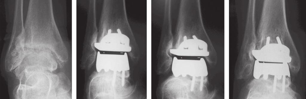 96 Figure 2 Patient #4: Radiographs in anteroposterior and lateral views of the right ankle at four different times: initial, three months after the operation, one year after the operation and four