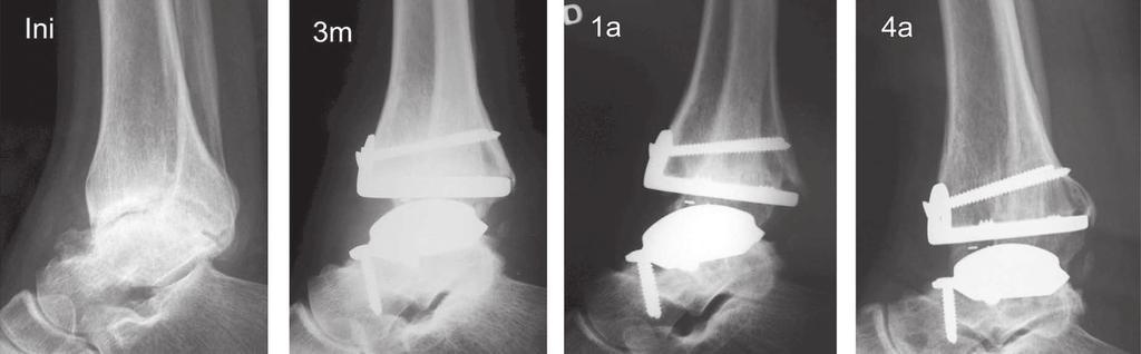 Despite good positioning of the prosthetic components, a radiolucent line appeared three months after the operation, in the contact area between the tibial component and the medial edge of the fibula.