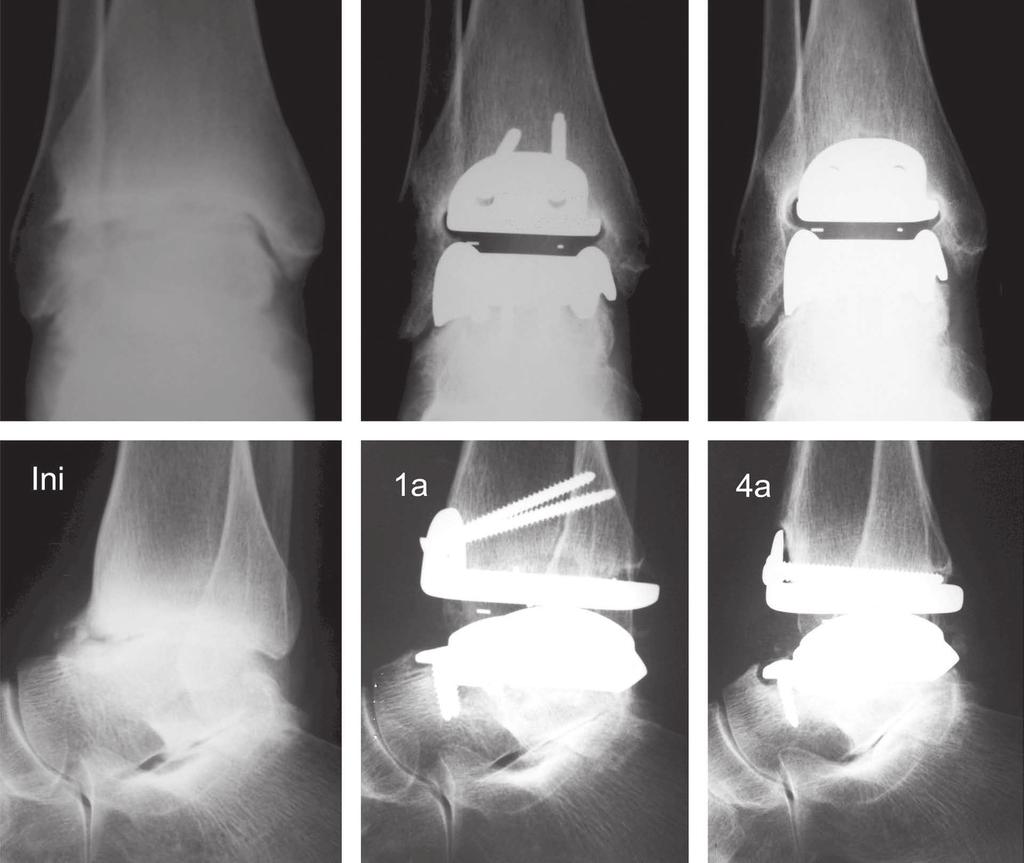 TOTAL ANKLE ARTHROPLASTY: BRAZILIAN EXPERIENCE WITH THE HINTEGRA PROSTHESIS 97 Figure 3 Patient #5: Radiographs in anteroposterior and lateral views of the right ankle at three different times: