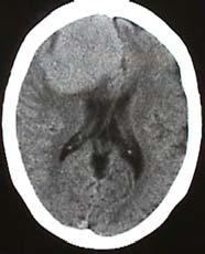 Danny TM Chan Neurosurgery Oct 29 2012 Classification of Brain Tumors Neoplastic