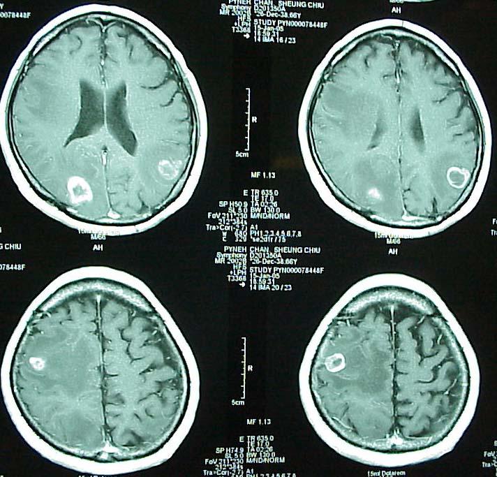 Brain Metastasis Is it worth doing?
