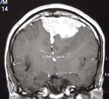 Meningioma Meningioma Commonest benign brain tumor Arachnoid cap cell Extra axial / shape margin / dural tail Calcification/