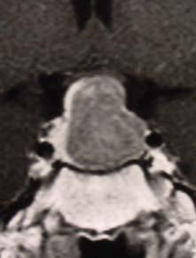hemianopsia Third ventricle hydrocephalus Cranial