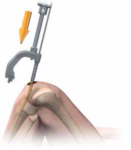 Additional reaming of the intramedullary canal may be indicated if excessive force is required to insert the nail.