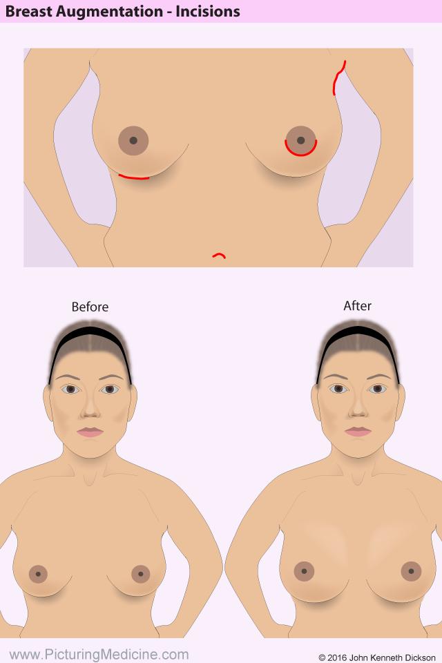 Your surgeon will examine your breasts, and may take some photographs for your medical records.