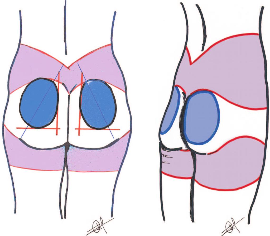 Plastic and Reconstructive Surgery March 2007 Fig. 1. (Left) Posterior view of the surgical design.