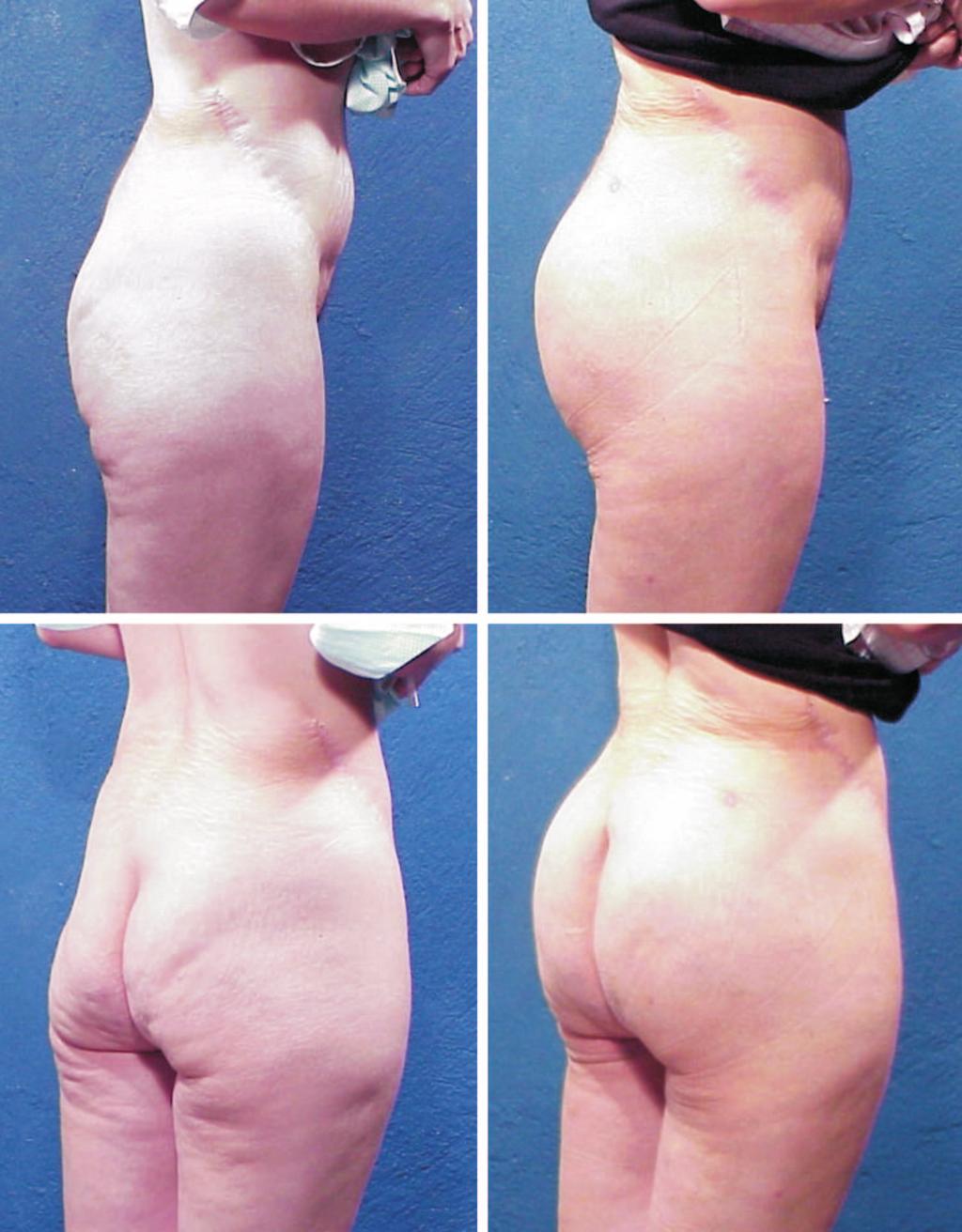 Plastic and Reconstructive Surgery March 2007 Fig. 2. Photographs of patient 1, aged 32 years, obtained 1 year after surgery with 300-cc gluteal implants.