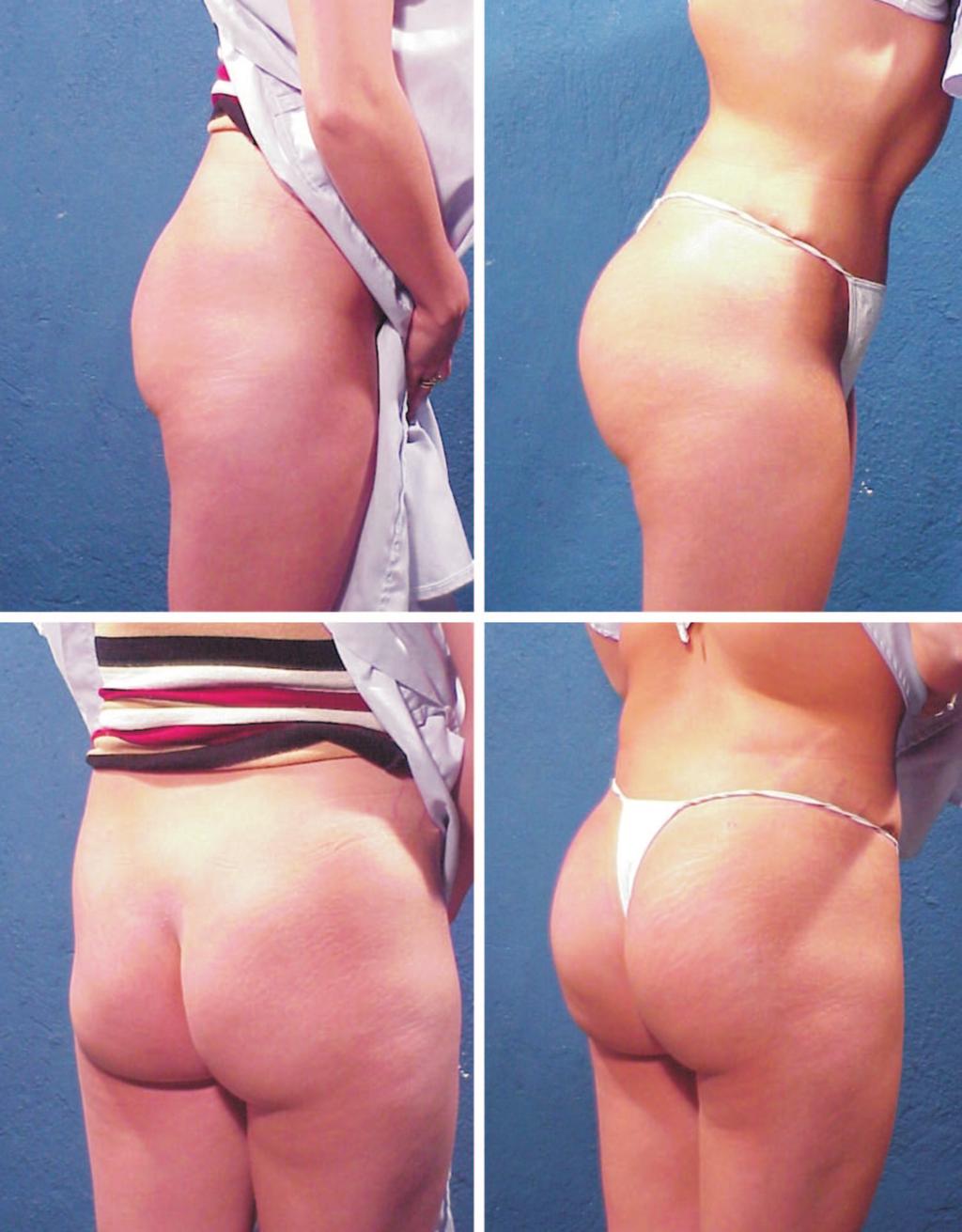 Plastic and Reconstructive Surgery March 2007 Fig. 4. Photographs of a 29-year-old patient obtained 6 months after surgery with 350-cc gluteal implants.