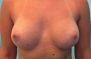 breast due to