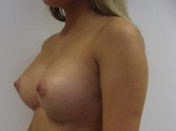 and conical shaped breast.