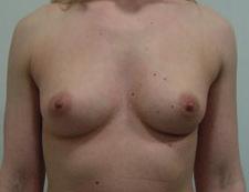 260CC LOW CONICAL BREAST