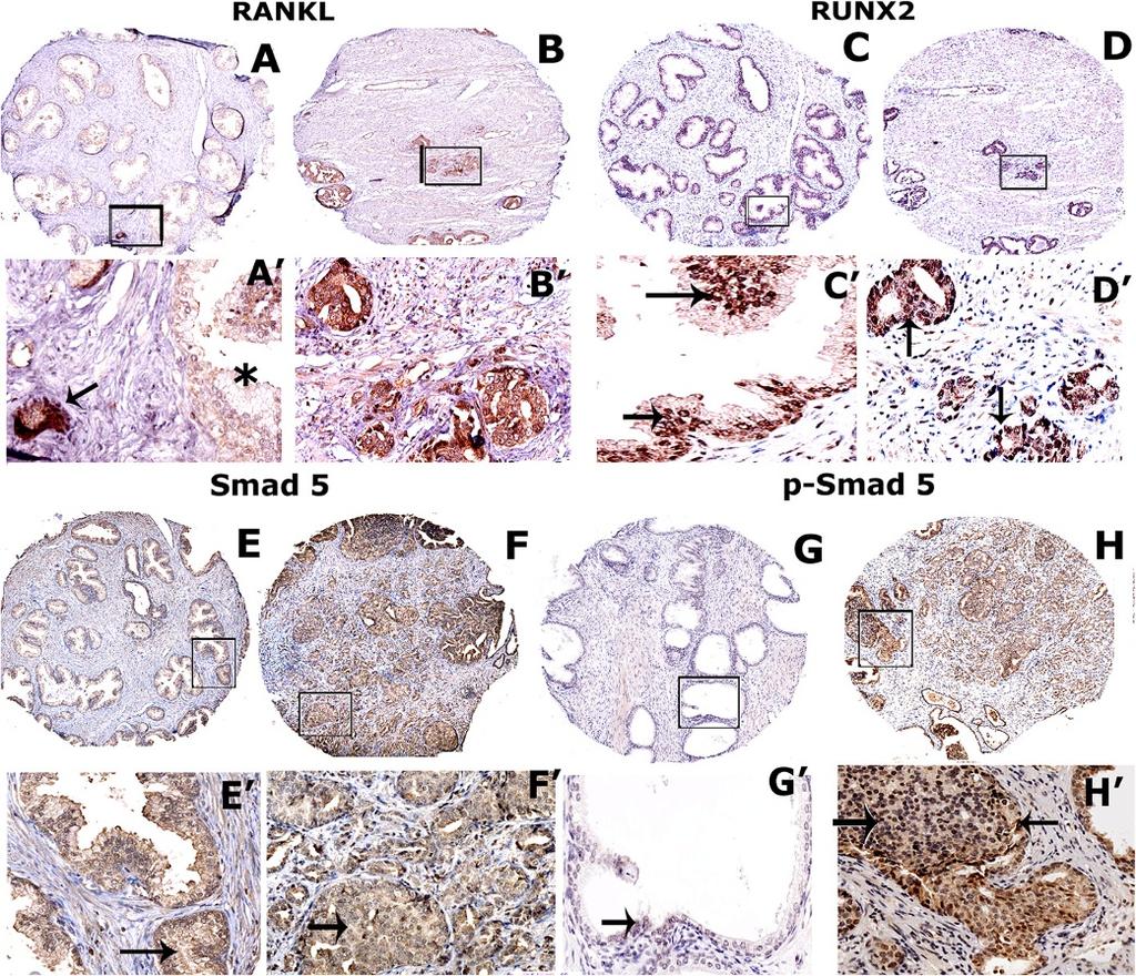 Gupta et al. Molecular Cancer 2012, 11:66 Page 10 of 17 Figure 10 Immunohistochemistry on TMA derived from normal and cancerous prostate tissue.