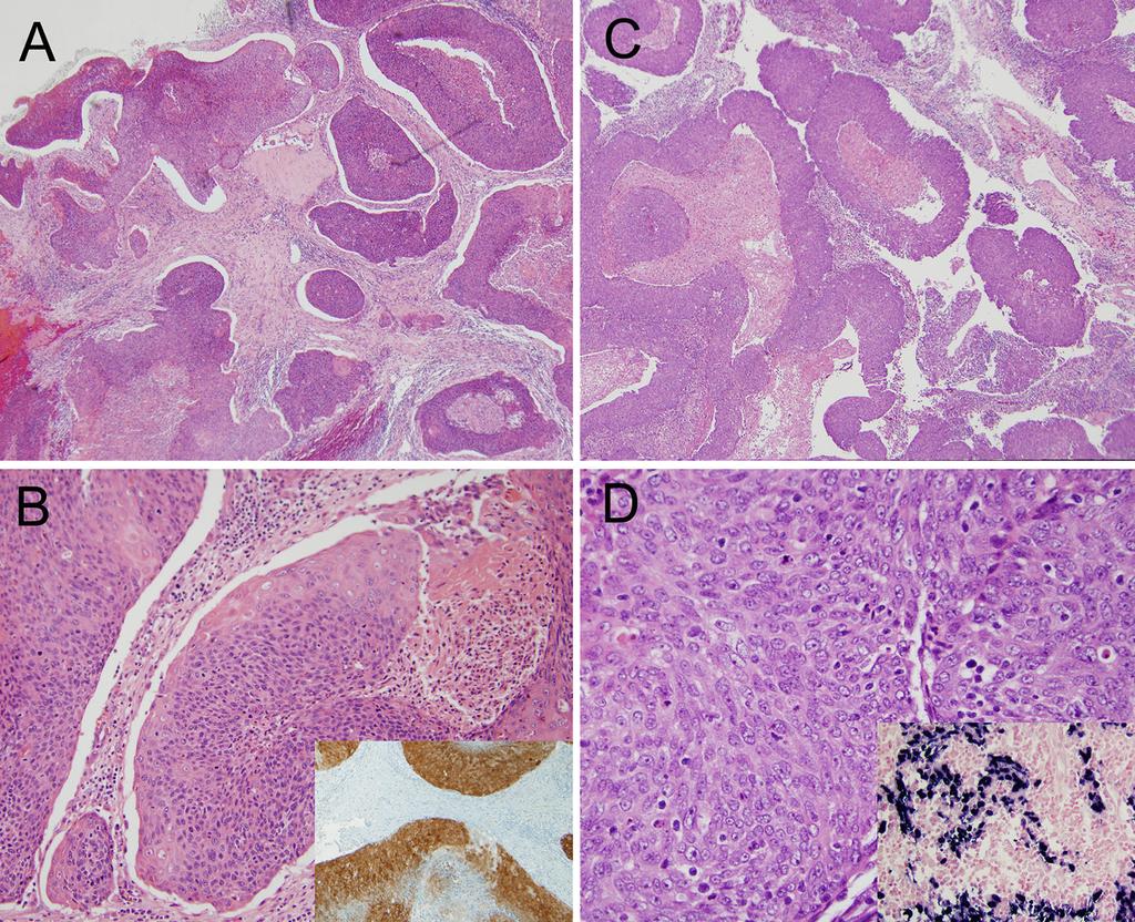56 Head and Neck Pathol (2014) 8:50 58 Fig. 5 Nasopharyngeal carcinoma. a, b An HPV-related nasopharyngeal carcinoma showing ribbons of blue tumor with smooth edges and central necrosis.