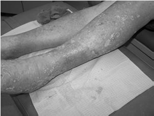 dermatitis Everyone Skin