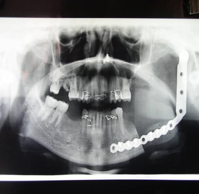 The patient s plasmacytois was localised to left mandibular ramus, although perineural and