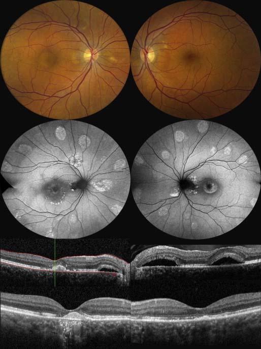3 a multiple myeloma presenting with multiple acquired vitelliform detachments involving the macula and midperiphery Fundus photographs show multifocal areas of subretinal yellow deposits OU separate