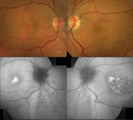 Fundus photographs show mild retinal pigment epithelium changes.