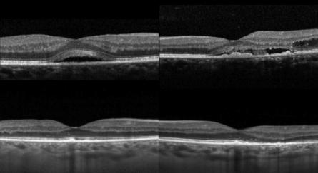 OCT at the level of these lesions shows a macular detachment with vitelliform deposition on the anterior surface of the RPE and the posterior surface of the neurosensory retina, more prominent OS and