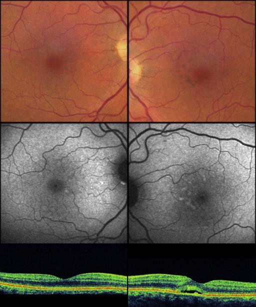 2 light chain deposition disease presenting with bilateral isolated acquired vitelliform lesions.