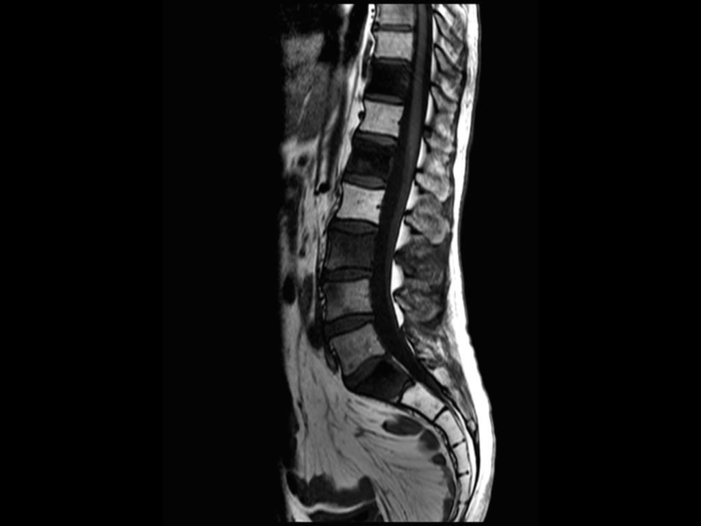 Fig. 6: MRI sagittal T1-weighted sequence lumbar spine: diffuse low