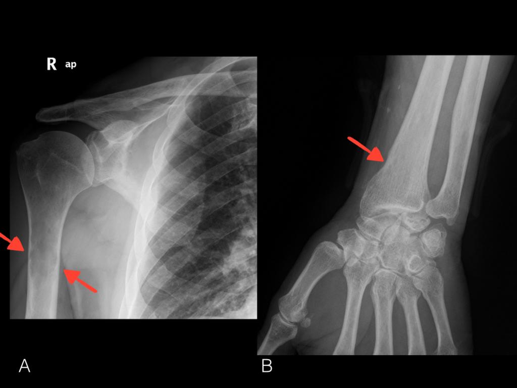 Fig. 2: Anteroposterior plain X-rays that show a large lytic lesion on the right umeral proximal diaphysis
