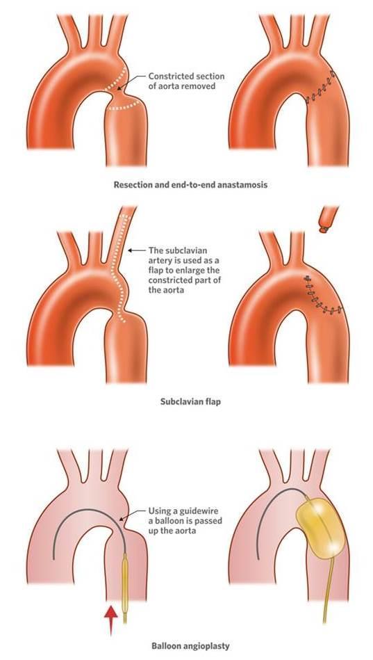 pathology of aorta