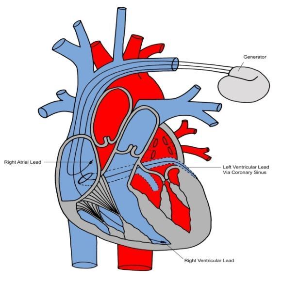 Pacemaker Procedures Insertion of temporary pacemaker: Singe chamber - 33210 (use for symptomatic bradycardia and generator exchange in