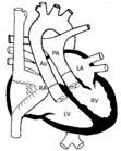palliation Transposition of the great arteries Patent ductus arteriosus Coarctation of the aorta Truncus