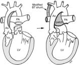 regurgitation CHD Pathophysiology Heart Failure Arrhythmias COMORBIDITIES Congenital & Acquired Ventricular