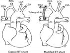 Single Ventricle Left vs Right, PLE Thromboembolic Liver Dysfunction 2. Tetralogy of Fallot PI, RV Dilation 3.