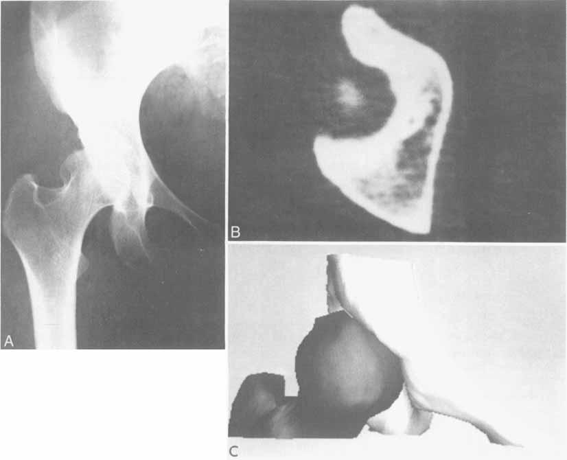 Number 261 December. 1990 Acetabular Dysplasia 21 7 FIGS. 4A-4C. Preoperative studies of a 29-year-old woman with residual hip dysplasia and pain. (A) AP roentgenogram.