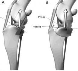 II Displace with flexion and medially directed pressure, reseats with extension Grade III Usually luxated, but can reseat patella in groove with