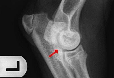 Fracture of the growth plate of the ulna in the medial trochlear