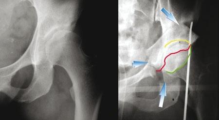 Ganz Periacetabular Osteotomy