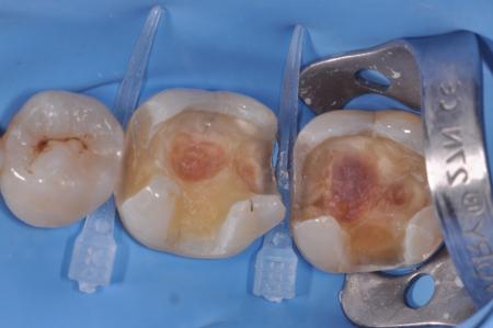5 For the final stage of the caries removal, a caries detector was applied for 10 seconds and washed.