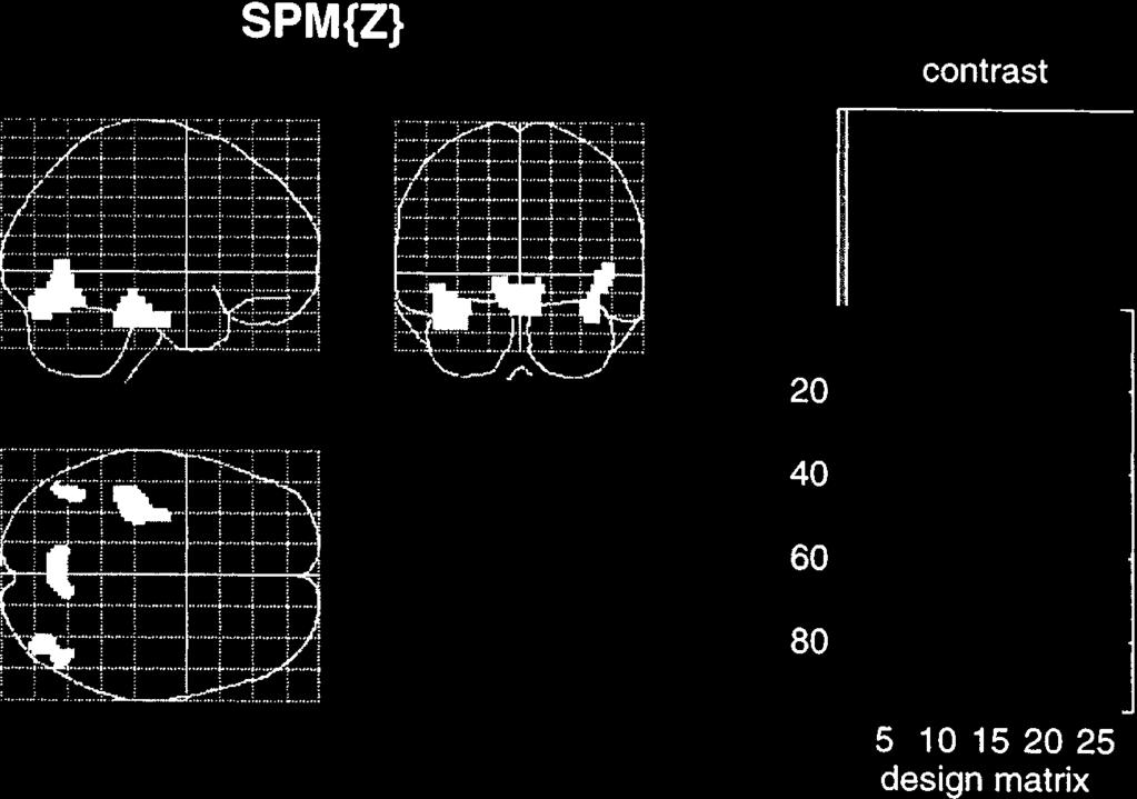 The interaction between activity in the medial parietal region (6, 74, 36 mm) and presence of faces was most significantly expressed in the right inferotemporal region ( 38, 30, 20 mm; Z 3.97, P 0.