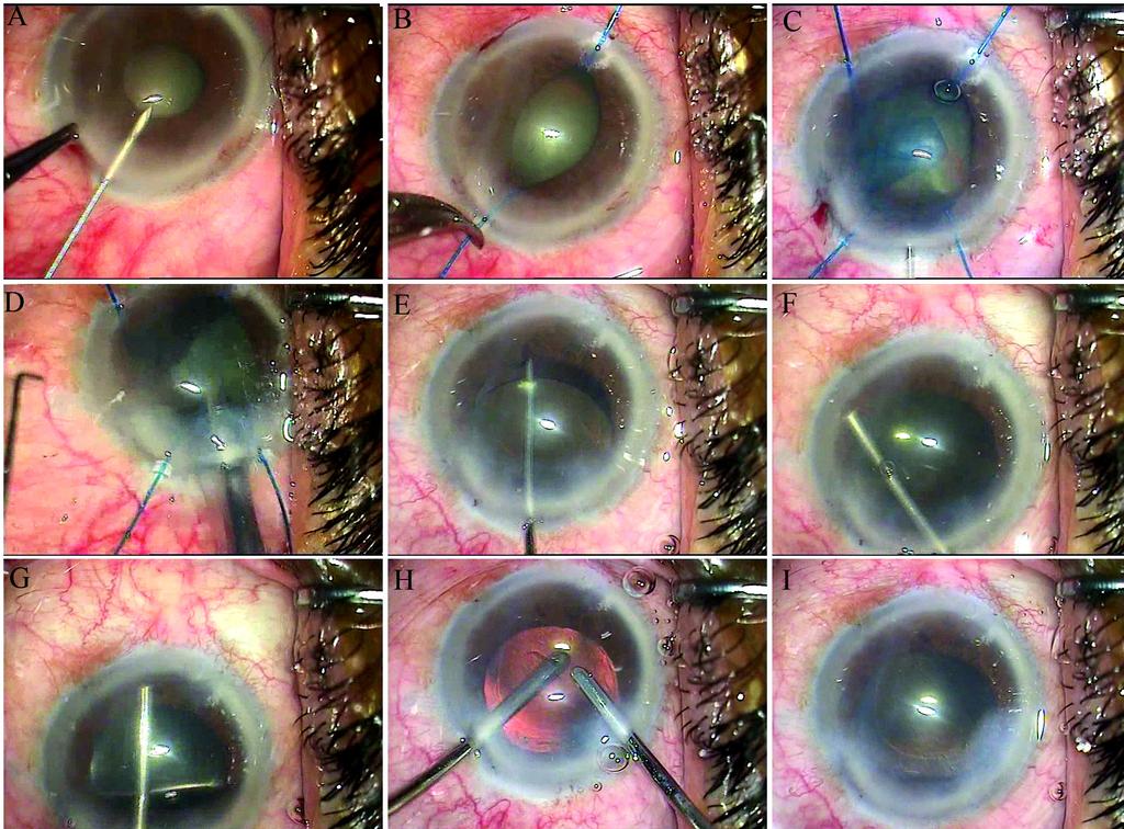 COMBINED PHACO AND VGS IN PACG 219 Figure 1. Performing combined phacoemulsification and viscogoniosynechialysis in a patient with angle-closure glaucoma and a miotic pupil.