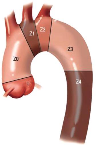 Treatment Criado Zonation 2005 The Aortic can be broken down into zones in order to help